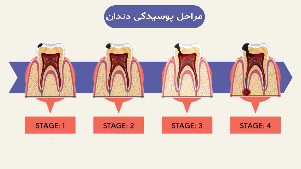 مراحل پوسیدگی دندان 