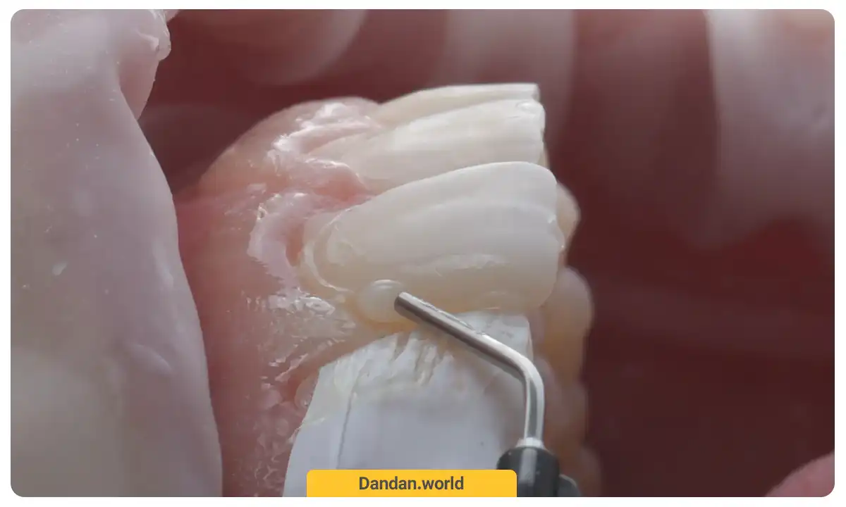 کامپوزیت دندان