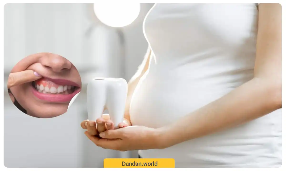 تورم لثه در دوران بارداری