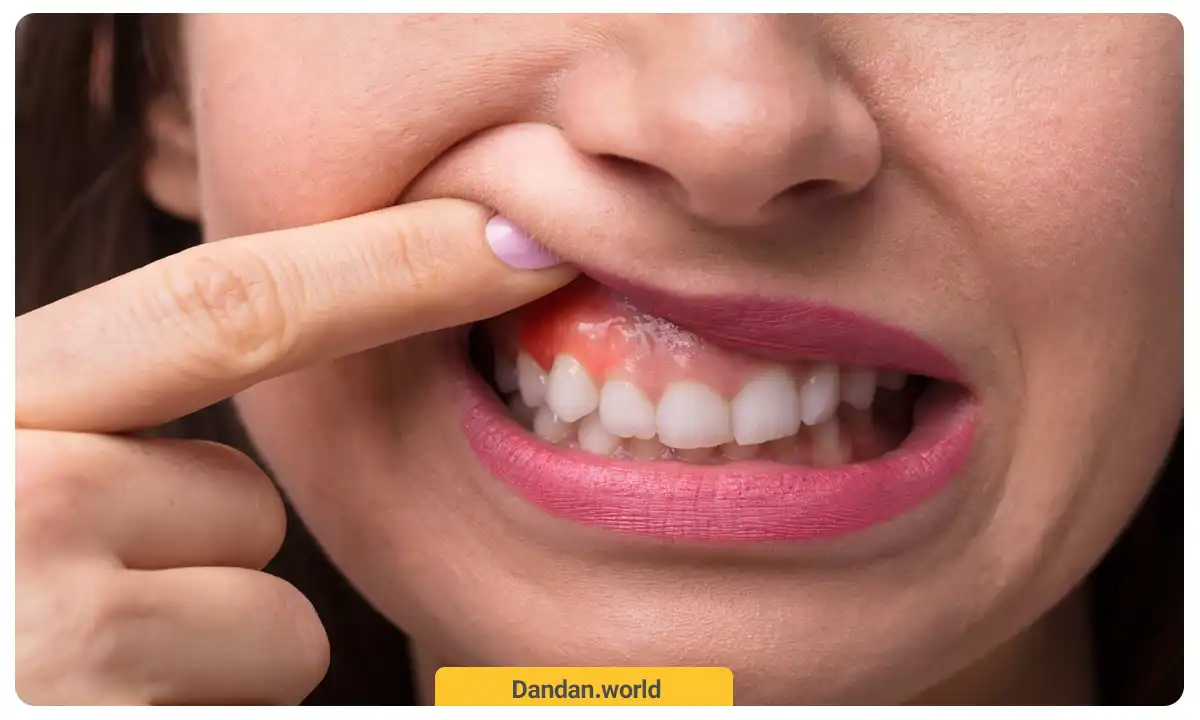 تورم لثه چیست و چگونه رخ می دهد 