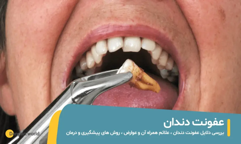 عفونت دندان