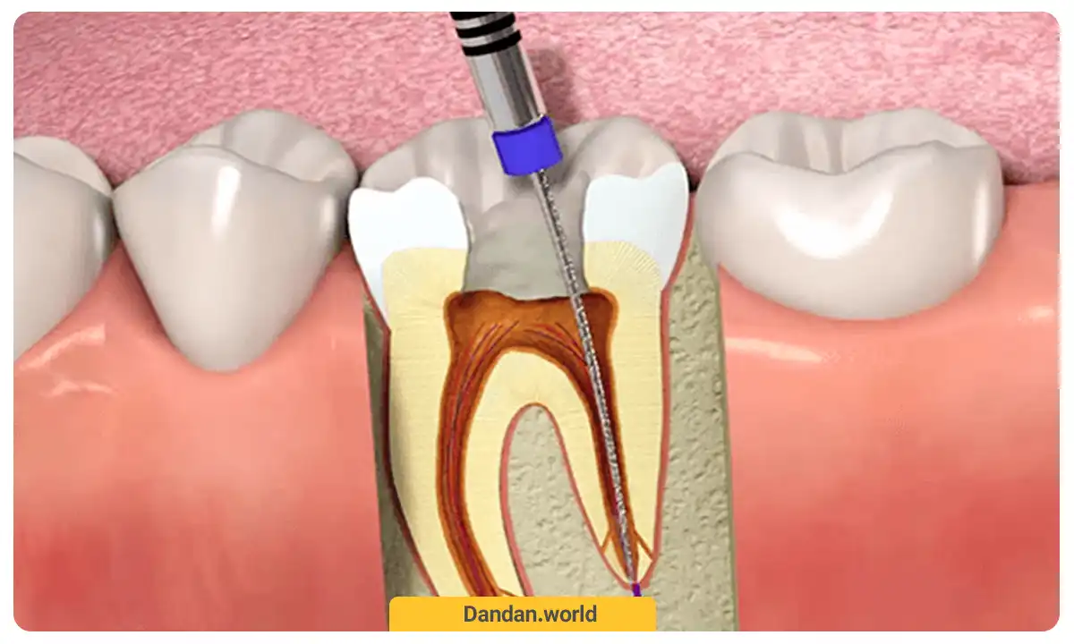 روش های درمان عفونت دندان