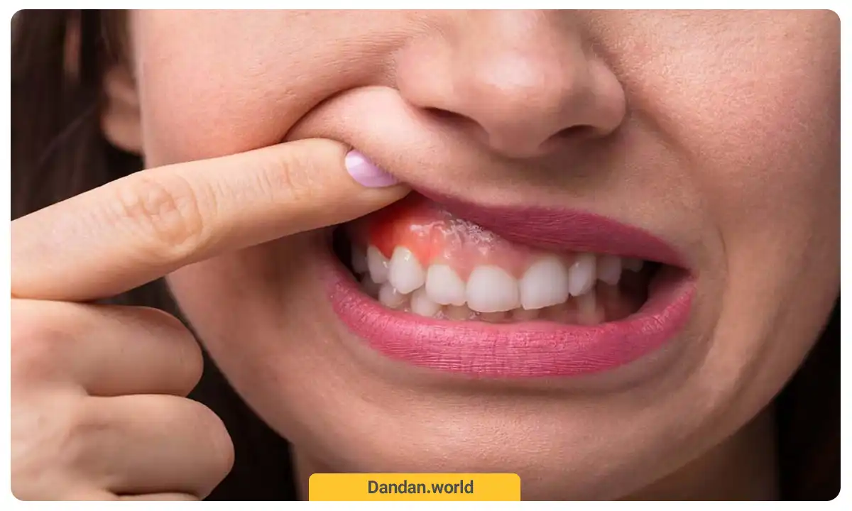 آبسه دندان یکی از عوارض عفونت دندان است