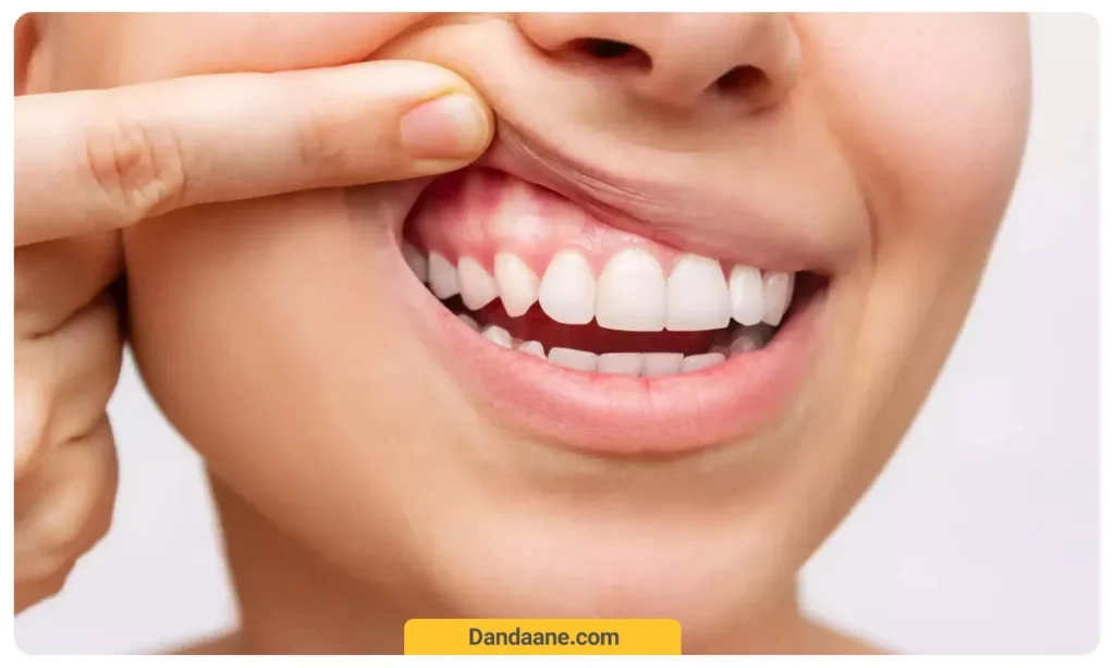 عکسی از تحلیل لثه