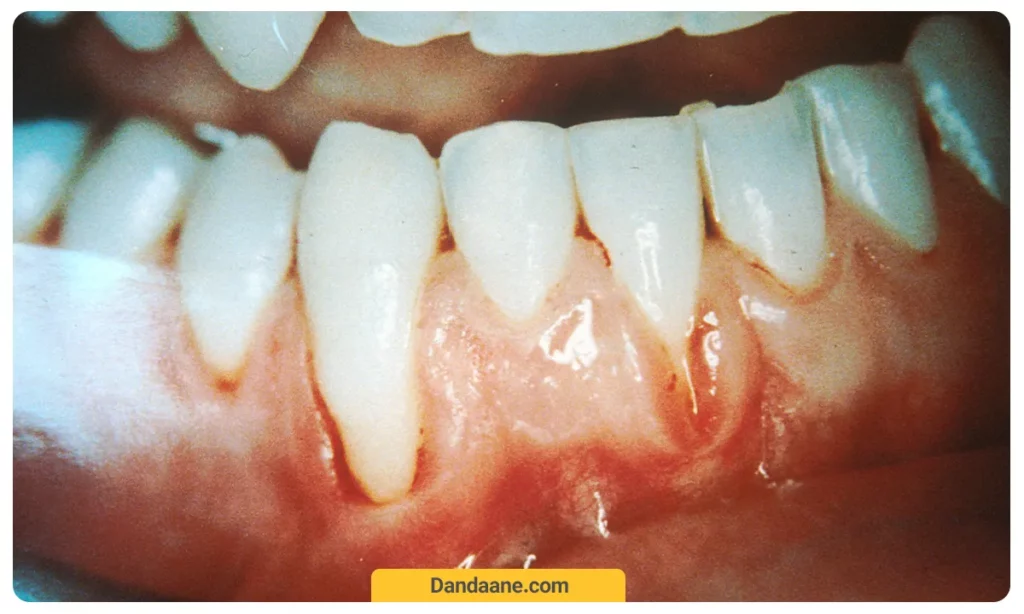 عکسی از تحلیل لثه دندان روکش شده