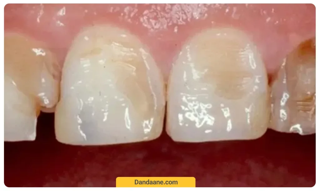 عکسی از فرسایش مینای دندان