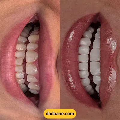 قبل و بعد نمونه کار کامپوزیت دندان دکتر مریم ولائی
