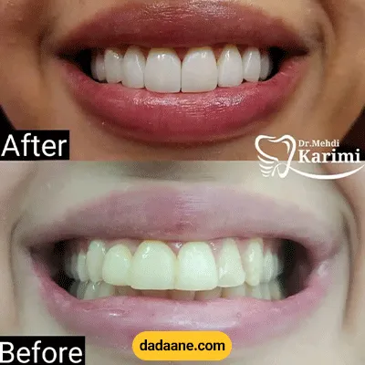 قبل و بعد نمونه کار کامپوزیت دندان توسط دکتر مهدی کریمی