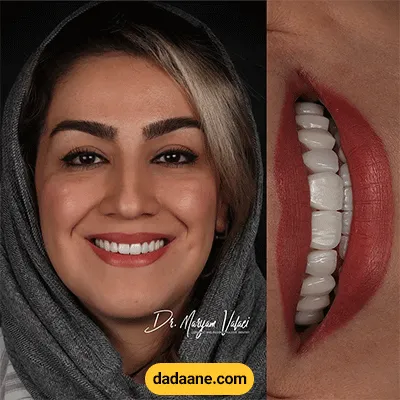 قبل و بعد نمونه کار لمینت دندان دکتر مریم ولائی