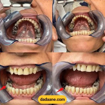 قبل و بعد نمونه کار پروتز دیجیتال دکتر علی مهرفرد