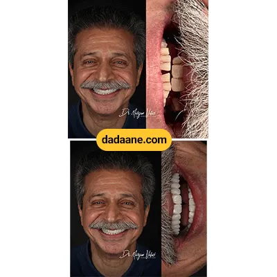 قبل و بعد نمونه کار ایمپلنت دکتر مریم ولائی