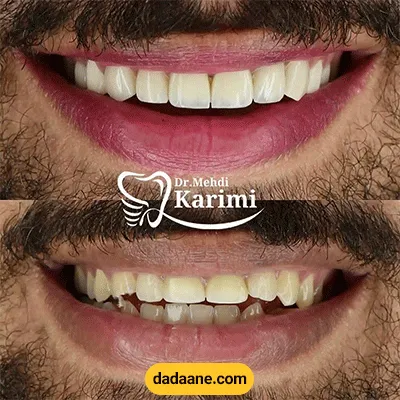 قبل و بعد نمونه کار سفید کردن دندان و نصب کامپوزیت دکتر مهدی کریمی
