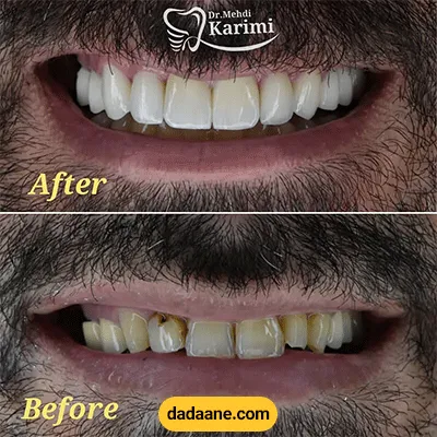 قبل و بعد نمونه کار سفید کردن دندان ها توسط دکتر مهدی کریمی