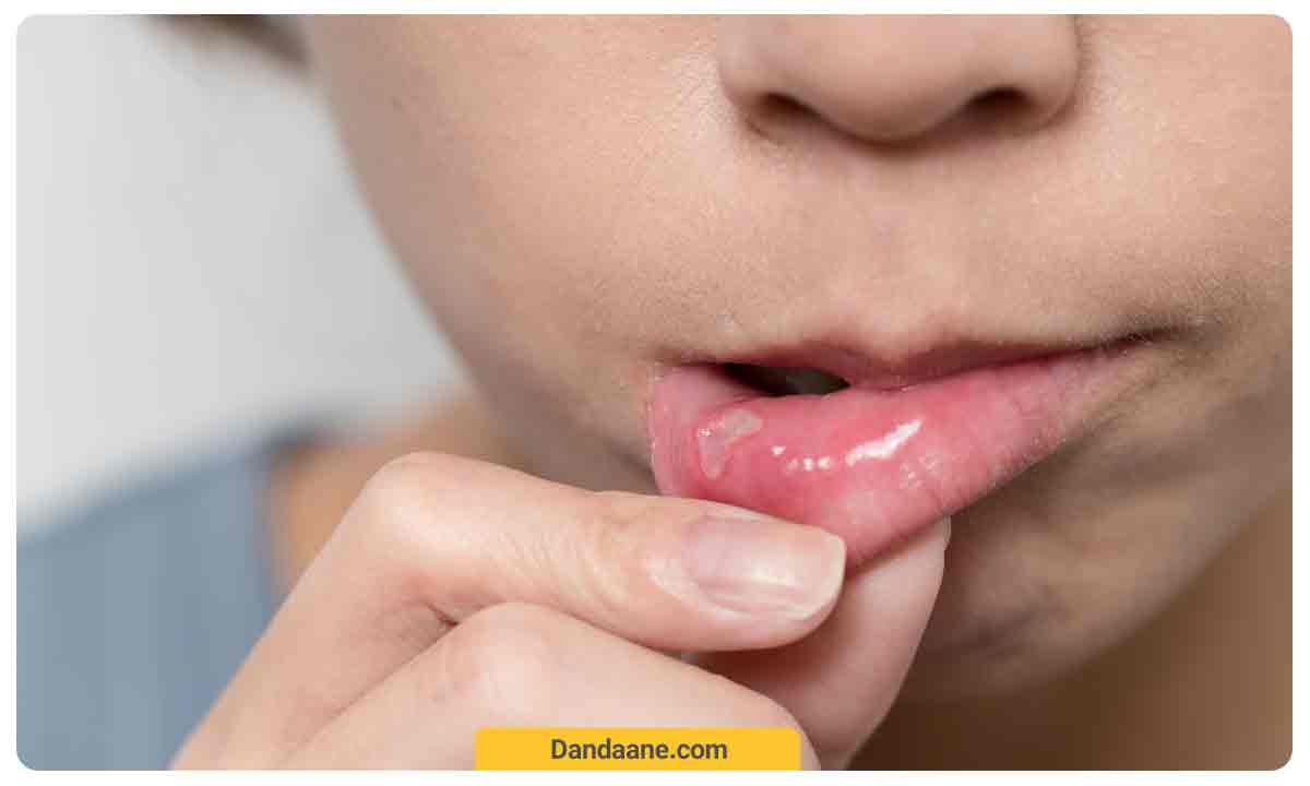 علل ایجاد آفت دهان