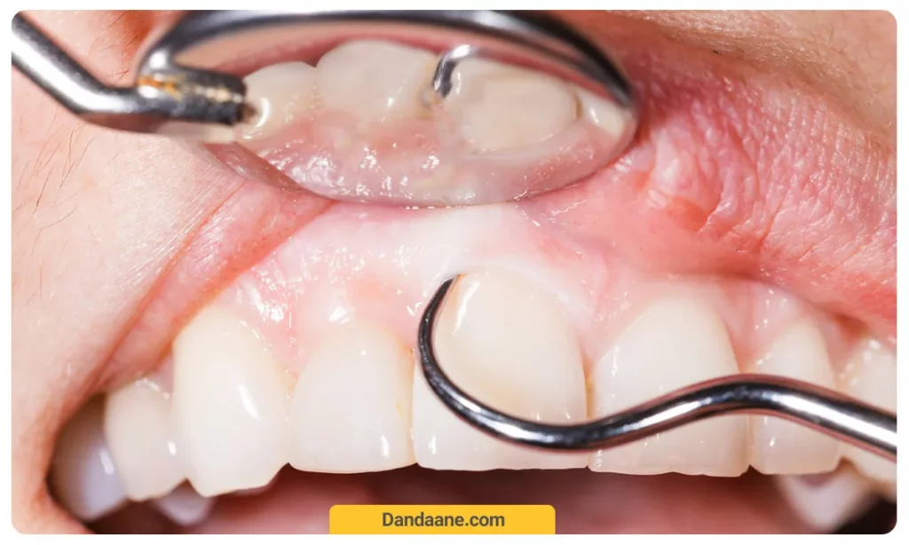 جرمگیری دندان برای درمان تحلیل لثه