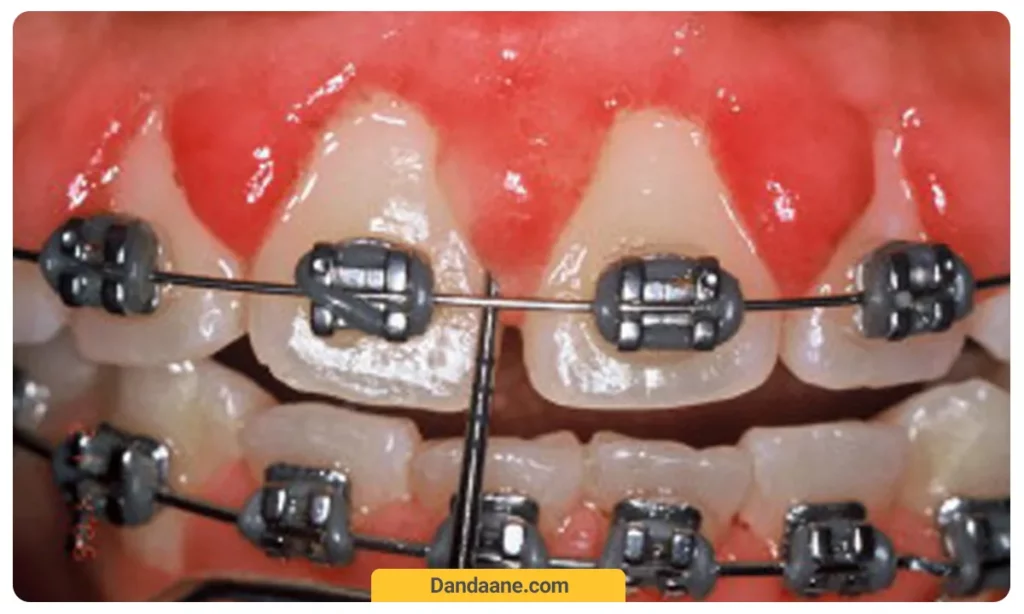تحلیل لثه در ارتودنسی