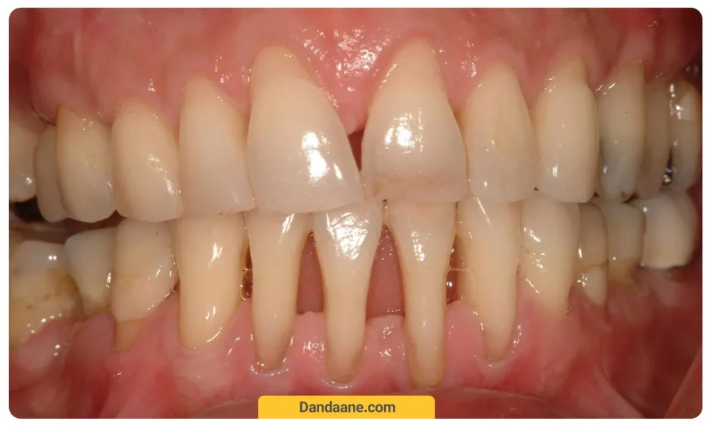 عکس تحلیل لثه شدید