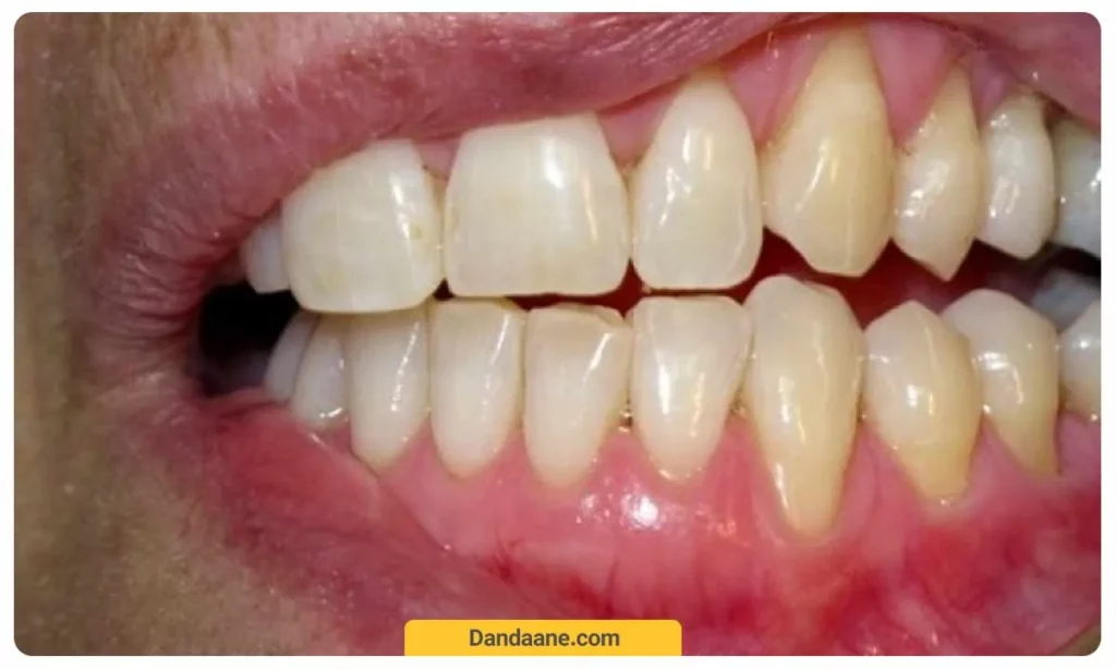 عکسی از بالا رفتن لثه ها
