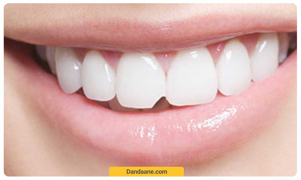 لب پر شدن دندان