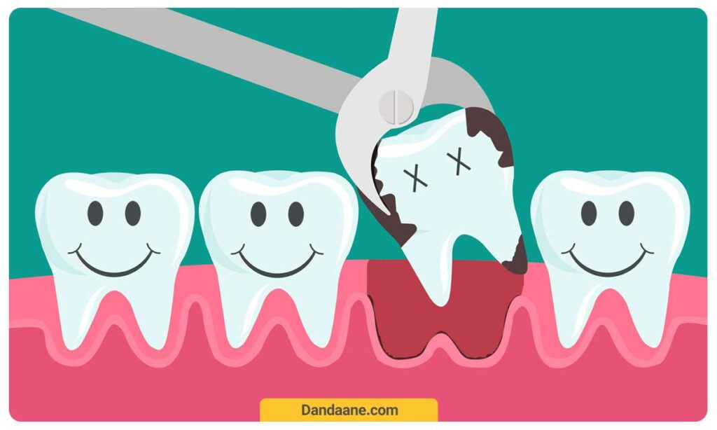 مصرف غذاهای گرم و سفت پس از کشیدن دندان باعث خونریزی دندان می شود