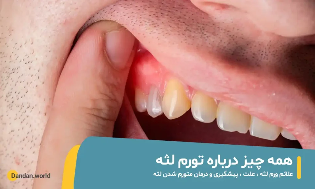 همه چیز درباره ورم لثه