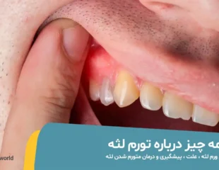همه چیز درباره ورم لثه
