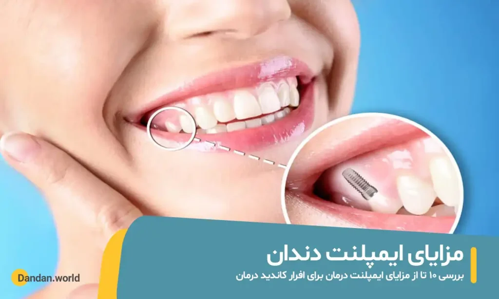 مزایای ایمپلنت دندان