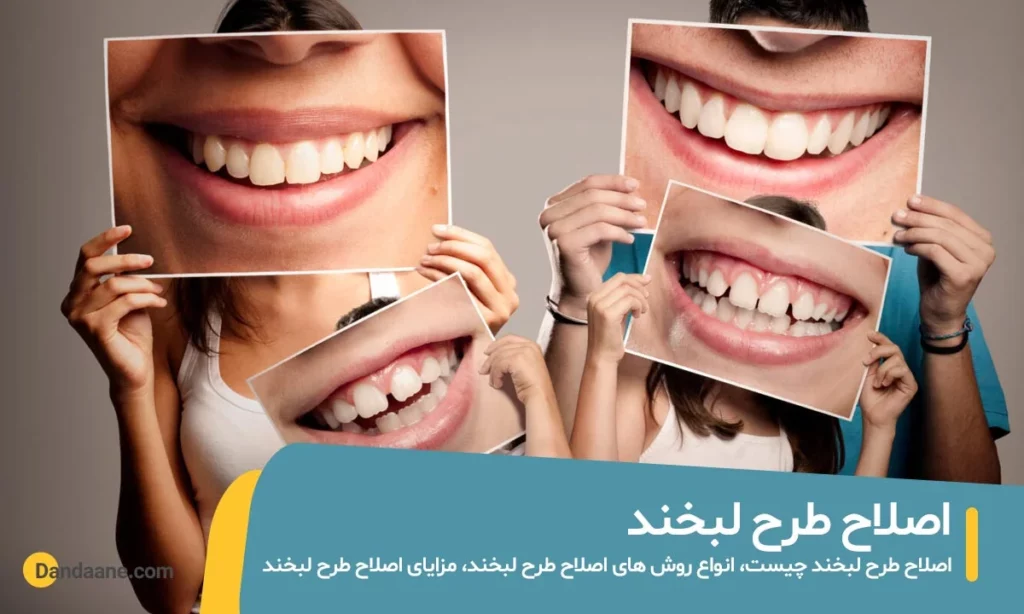 اصلاح طرح لبخند