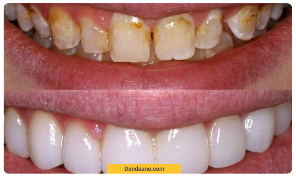 عکس قبل و بعد لمینت دندان