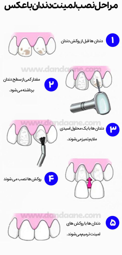 مراحل نصب لمینت دندان با عکس