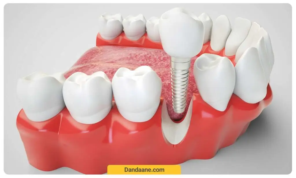 نحوه جاگذاری ایمپلنت دندان