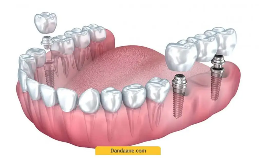 ایمپلنت دندان