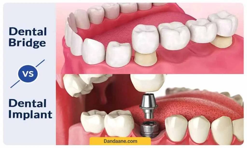 مقایسه ایمپلنت با بریج دندان