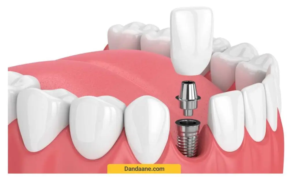 بریج یا ایمپلنت دندان
