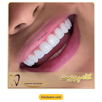 نمونه کار بعد کامپوزیت دندان دکتر سعید میرزایی شماره 1