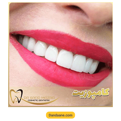 نمونه کار بعد کامپوزیت دندان دکتر سعید میرزایی