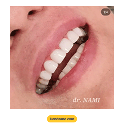 نمونه کار بعد کامپوزیت دندان دکتر محمد نامی