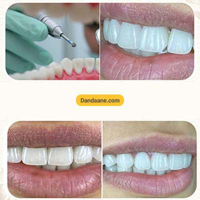 نمونه کار قبل و بعد کامپوزیت دندان دکتر سعید میرزایی شماره 1