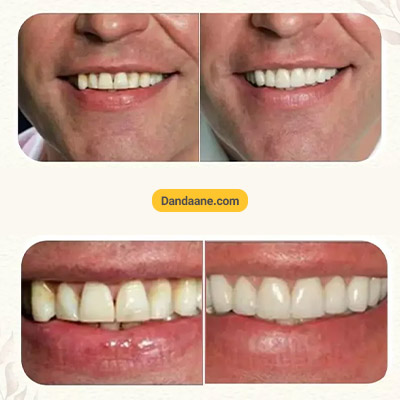 نمونه کار قبل و بعد کامپوزیت دندان دکتر سعید میرزایی شماره 2