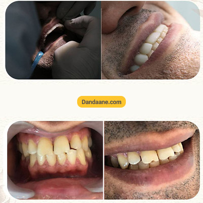 نمونه کار قبل و بعد کامپوزیت دندان دکتر سعید میرزایی