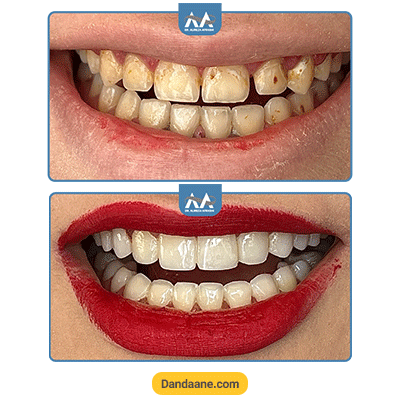 نمونه کار قبل و بعد کامپوزیت دندان دکتر علیرضا افراشی - شماره 2