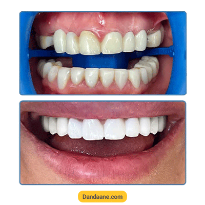 نمونه کار قبل و بعد کامپوزیت دندان دکتر علیرضا افراشی