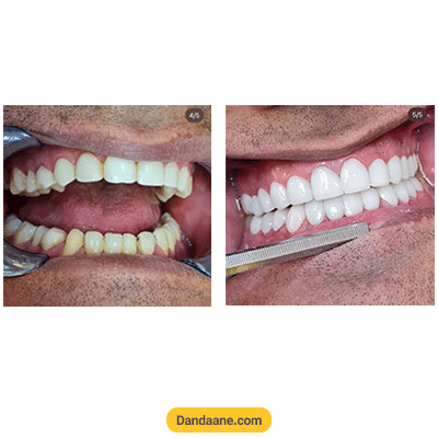 نمونه کار قبل و بعد کامپوزیت دندان دکتر محمد نامی