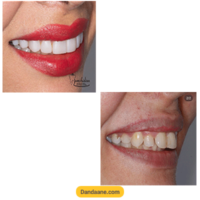 نمونه کار قبل و بعد کامپوزیت دندان دکتر مهدیه جمشیدیان شماره 1