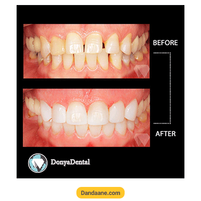 نمونه کار قبل و بعد کامپوزیت کلینیک دندانپزشکی دنیا دنتال