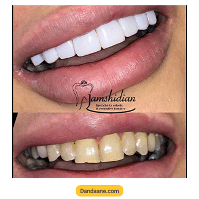 نمونه کار کامپوزیت دندان دکتر مهدیه جمشیدیان