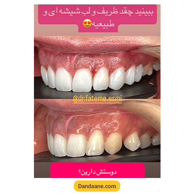 نمونه کار کامپوزیت دندان دکتر فاطمی اسمی - شماره 1