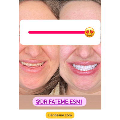 نمونه کار کامپوزیت دندان دکتر فاطمی اسمی - شماره 2