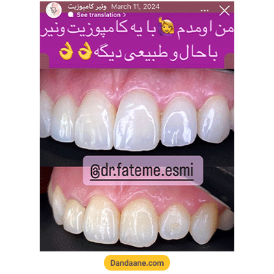 نمونه کار کامپوزیت دندان دکتر فاطمی اسمی - شماره 3