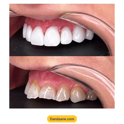 نمونه کار کامپوزیت دندان دکتر فاطمی اسمی - شماره 4